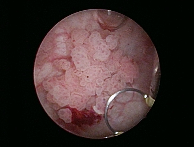 膀胱癌の内視鏡所見（切除に使用するループも観察できる。）